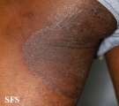 tinea corporis