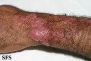 tinea corporis
