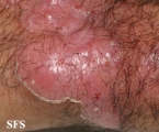 tinea corporis