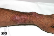 tinea corporis