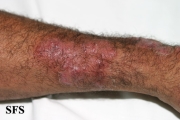 tinea corporis