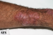 tinea corporis
