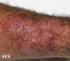 tinea corporis