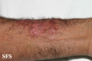 tinea corporis