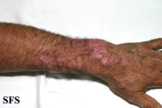 tinea corporis