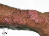 tinea corporis