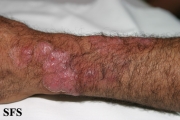 tinea corporis