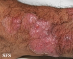 tinea corporis