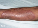 tinea corporis