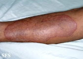 tinea corporis