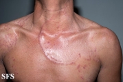 tinea corporis