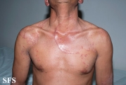 tinea corporis