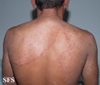 tinea corporis