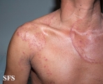 tinea corporis