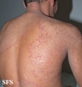 tinea corporis