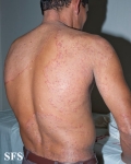 tinea corporis