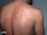 tinea corporis