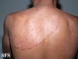 tinea corporis