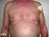 tinea corporis