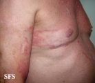 tinea corporis