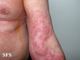 tinea corporis