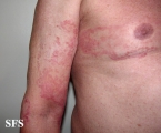 tinea corporis