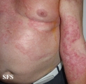 tinea corporis