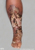 erysipelas