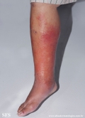 erysipelas