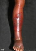 erysipelas