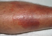 erysipelas