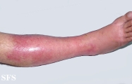erysipelas