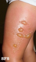 erysipelas