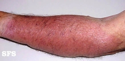 erysipelas