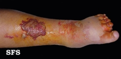 erysipelas