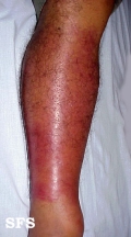 erysipelas