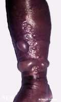 erysipelas