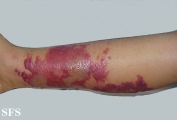 erysipelas