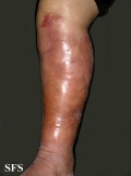 erysipelas