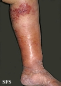 erysipelas