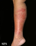 erysipelas