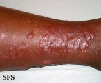 erysipelas