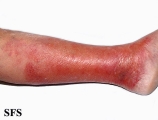 erysipelas