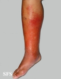 erysipelas