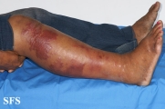 erysipelas