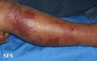 erysipelas