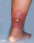 erysipelas