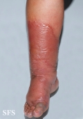 erysipelas