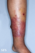 erysipelas
