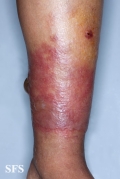 erysipelas